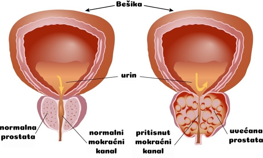 BENIGNA HIPERPLAZIJA PROSTATE